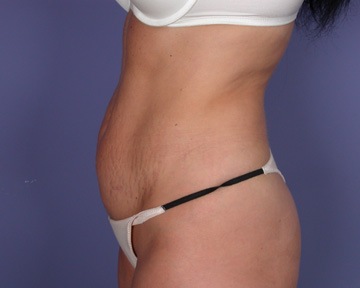 Liposuction before and after photo