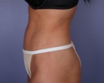 Liposuction Before and after photo