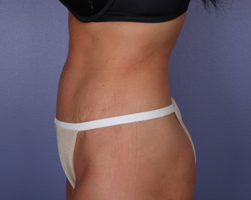 Liposuction before and after photo