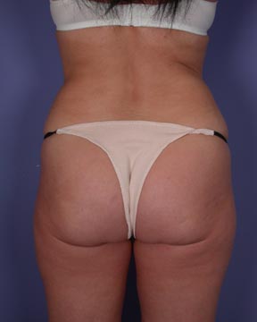 Liposuction before and after photo