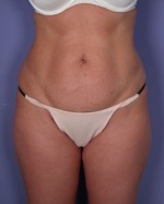 Liposuction Before and after photo