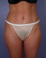 Liposuction Before and after photo