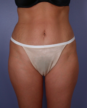 Liposuction before and after photo