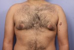 Liposuction Before and after photo