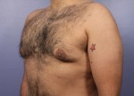 Liposuction Before and after photo