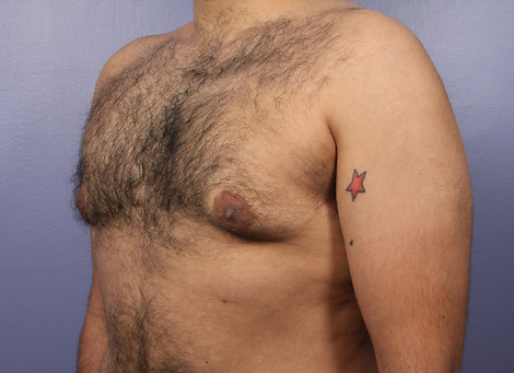 Liposuction before and after photo