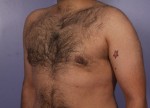 Liposuction Before and after photo