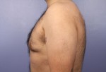 Liposuction Before and after photo