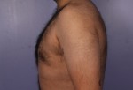 Liposuction Before and after photo