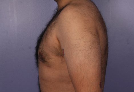 Liposuction before and after photo