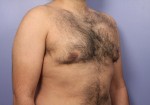 Liposuction Before and after photo