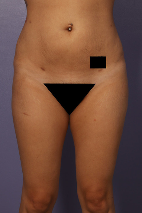 Liposuction before and after photo