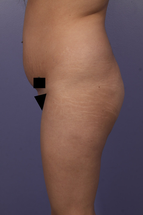 Liposuction before and after photo