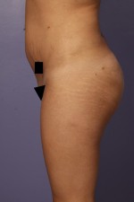 Liposuction Before and after photo