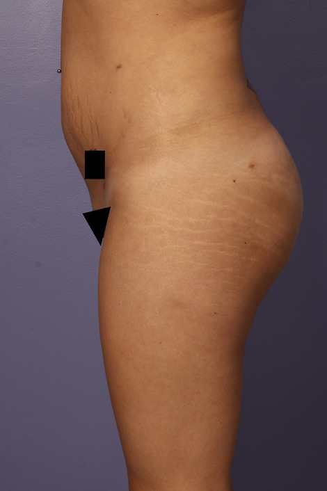 Liposuction before and after photo