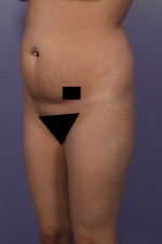 Liposuction Before and after photo