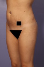 Liposuction Before and after photo