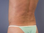 Liposuction Before and after photo