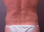 Liposuction Before and after photo