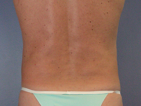 Liposuction before and after photo