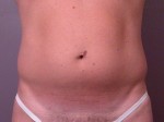 Liposuction Before and after photo