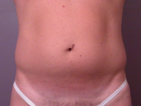 Liposuction before and after photo