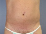 Liposuction Before and after photo