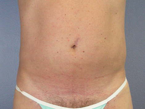 Liposuction before and after photo