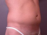 Liposuction Before and after photo