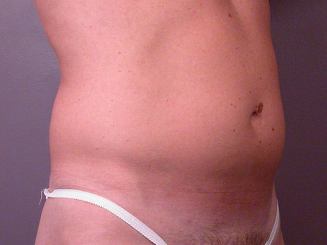 Liposuction before and after photo