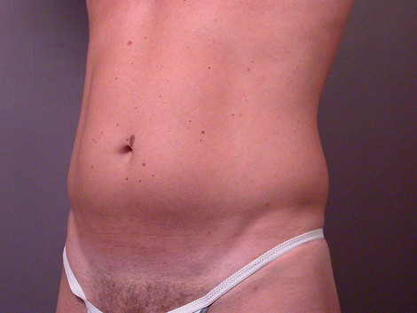 Liposuction before and after photo