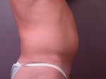 Liposuction Before and after photo