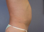 Liposuction Before and after photo