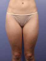 Liposuction Before and after photo