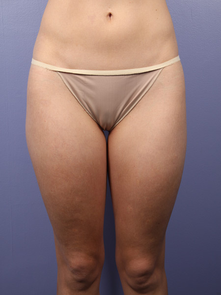 Liposuction before and after photo