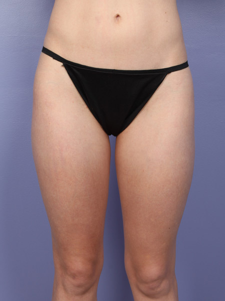 Liposuction before and after photo