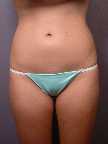 Liposuction before and after photo