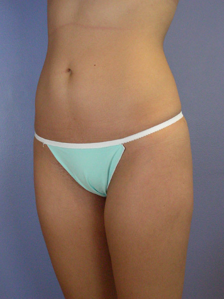 Liposuction before and after photo