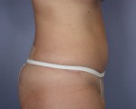 Liposuction Before and after photo