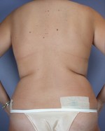 Liposuction Before and after photo