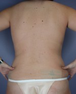 Liposuction Before and after photo