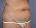 Liposuction Before and after photo