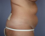 Liposuction Before and after photo