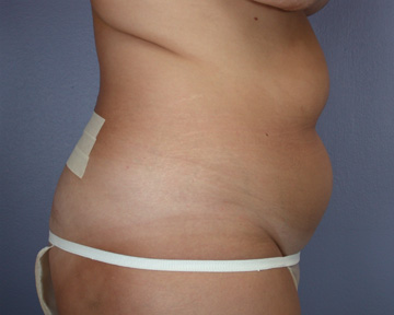 Liposuction before and after photo