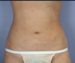 Liposuction