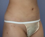 Liposuction Before and after photo