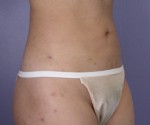 Liposuction Before and after photo