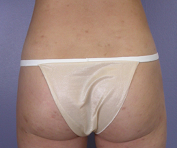 Liposuction before and after photo