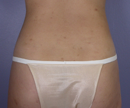 Liposuction before and after photo