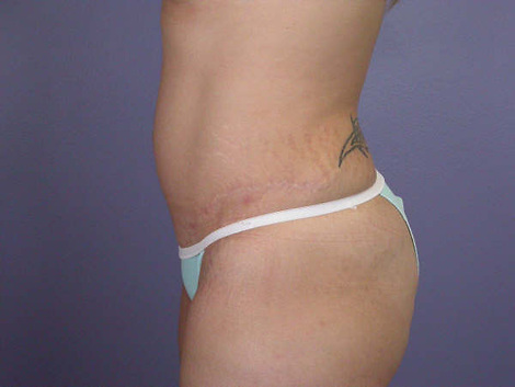 Liposuction before and after photo